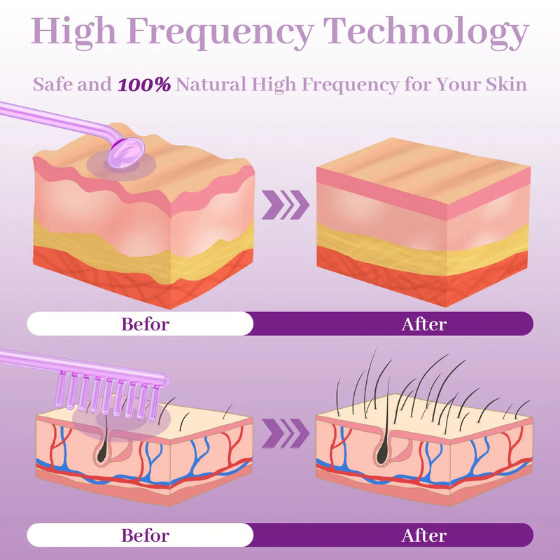 High Wave Electrotherapy Rod